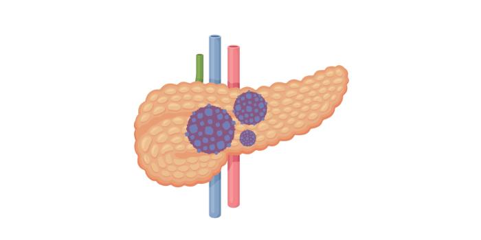 Number 12: Cancer - Obesity is associated with cancers like liver, kidney, colon, and pancreatic, among others.